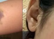 Viral, Seorang Perempuan Bagikan Foto Lebam-lebam Diduga Dianiaya Seorang Polisi
