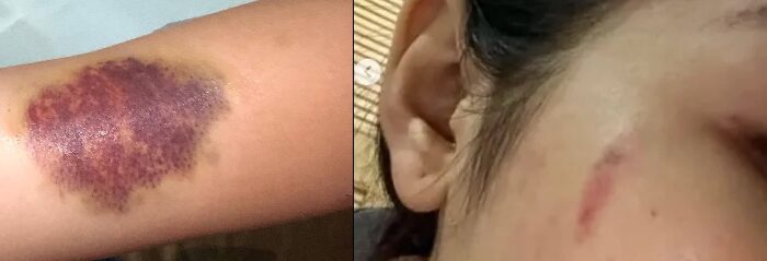 Viral, Seorang Perempuan Bagikan Foto Lebam-lebam Diduga Dianiaya Seorang Polisi